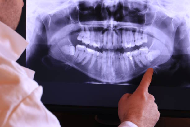 Best Emergency Tooth Extraction in Decatur, GA