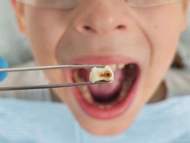 Best Emergency Treatment for Dental Infections or Abscesses in Decatur, GA